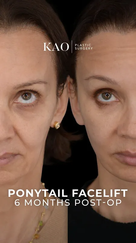 Before and after — Dr. Chia Chi Kao