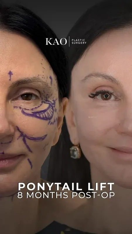 Before and after — Dr. Chia Chi Kao