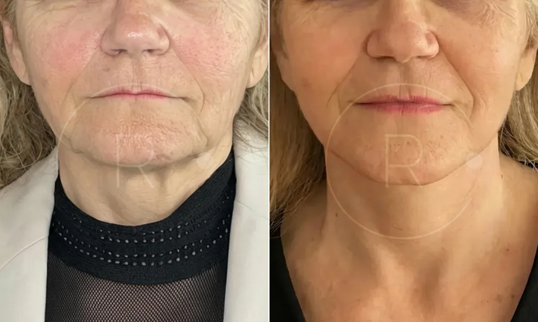 Before and after — Dr. Christophe Reinbold