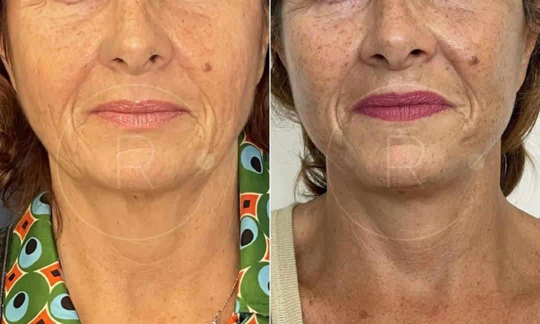 Before and after — Dr. Christophe Reinbold