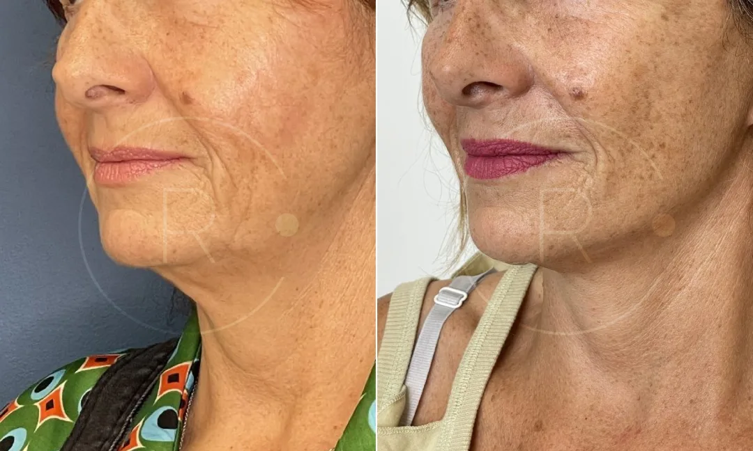 Before and after — Dr. Christophe Reinbold
