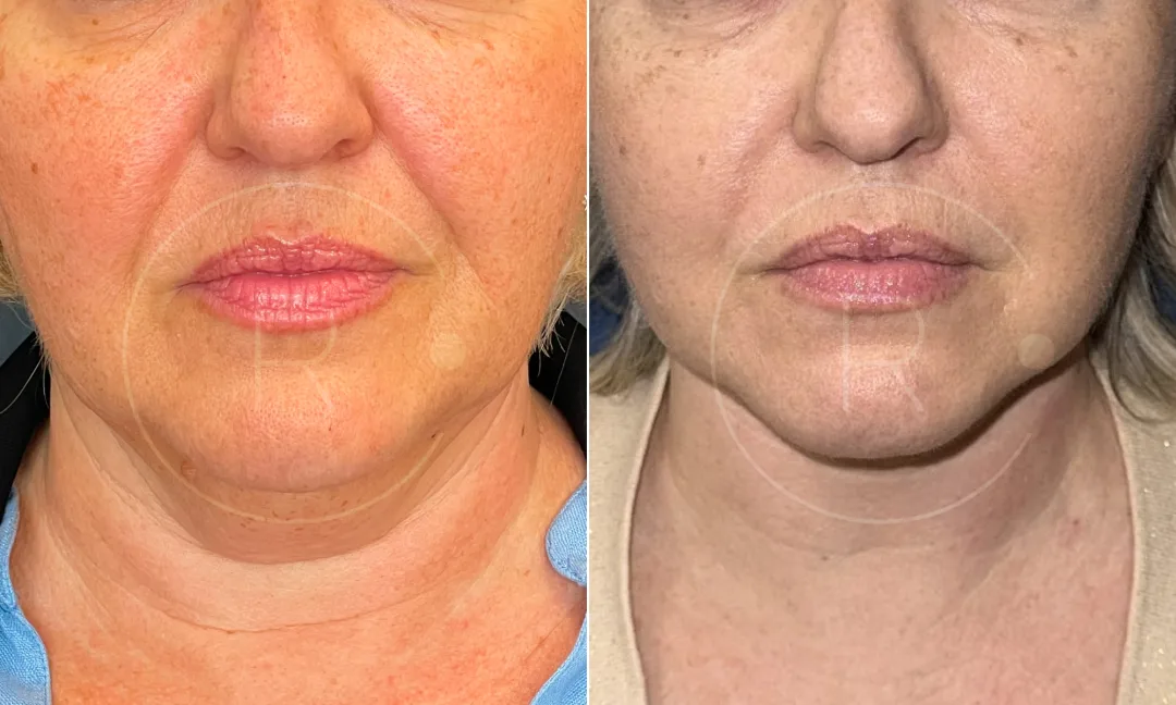 Before and after — Dr. Christophe Reinbold