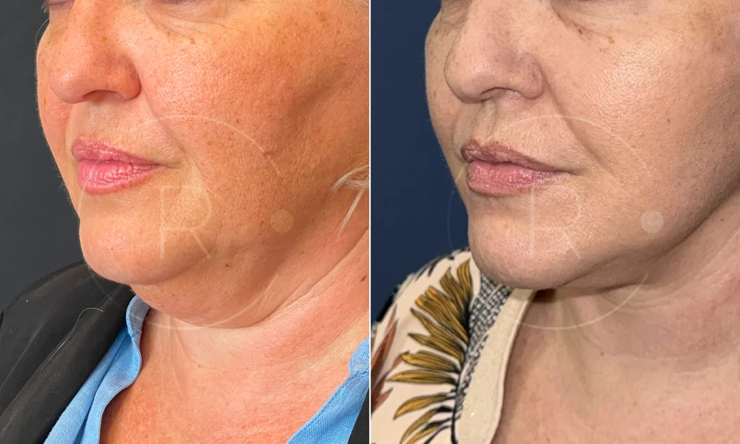 Before and after — Dr. Christophe Reinbold