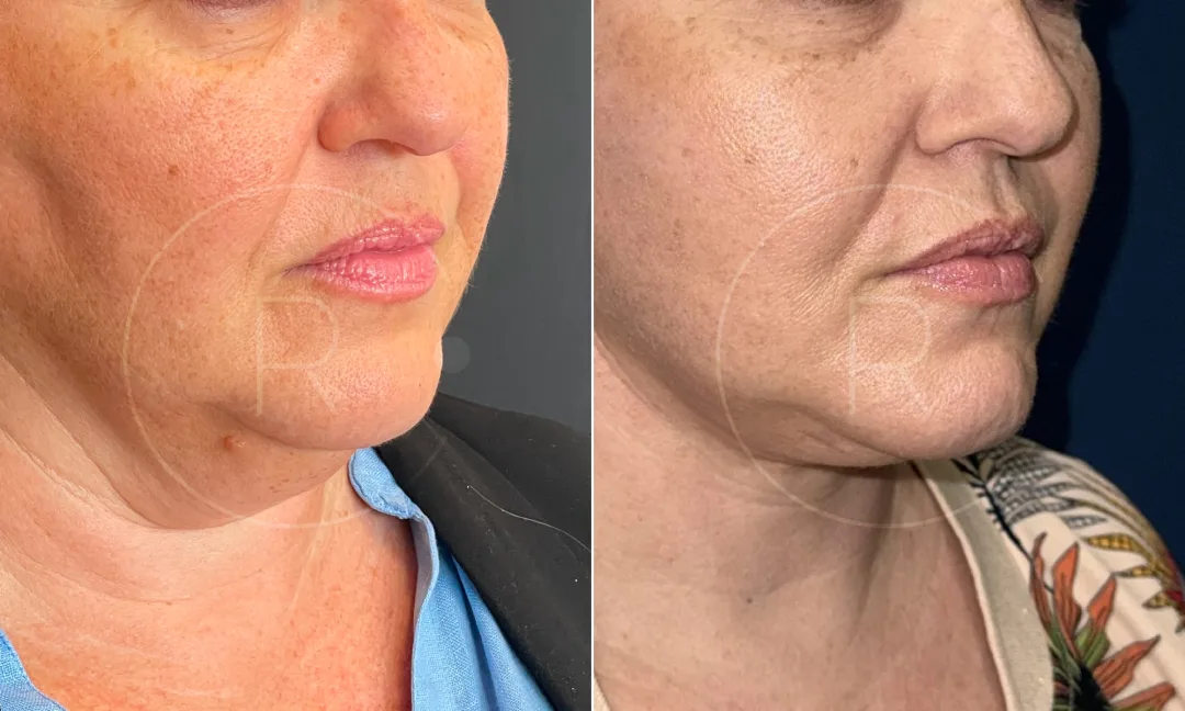 Before and after — Dr. Christophe Reinbold