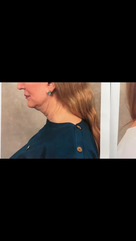 Before and after deep plane facelift — -1-year-old patient, frontal view by Dr. Colin McInnes
