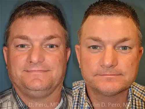 Before and after deep plane facelift — 50-year-old man, frontal view, 12mo post-op by Dr. Colin Pero