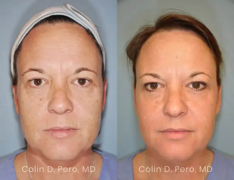 Before and after deep plane facelift — 55-year-old woman, frontal view, 12mo post-op by Dr. Colin Pero
