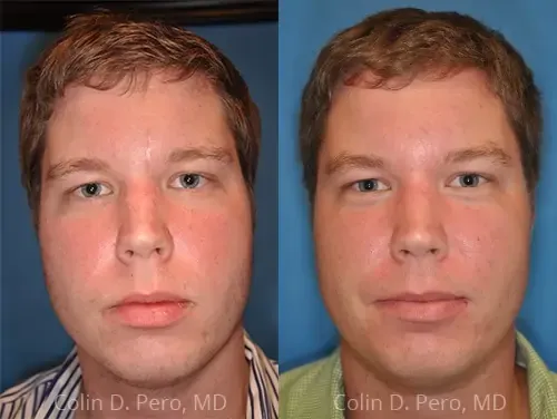 Before and after deep plane facelift — 35-year-old man, frontal view, 7mo post-op by Dr. Colin Pero