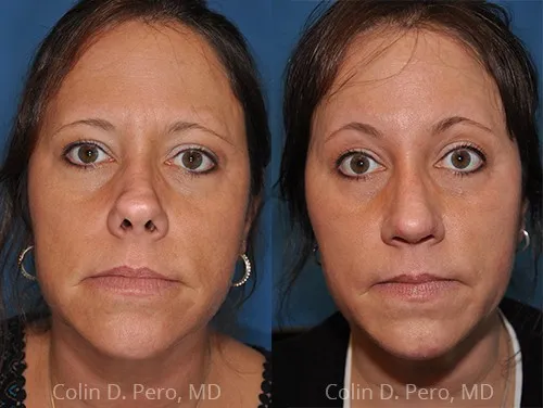 Before and after deep plane facelift — 50-year-old woman, frontal view, 12mo post-op by Dr. Colin Pero
