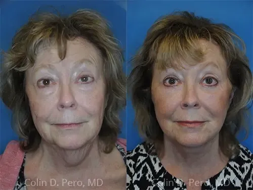 Before and after deep plane facelift — 68-year-old woman, frontal view, 9mo post-op by Dr. Colin Pero