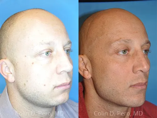 Before and after deep plane facelift — 35-year-old man, oblique left view, 3mo post-op by Dr. Colin Pero