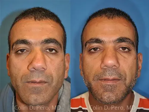 Before and after deep plane facelift — 45-year-old man, frontal view, 7mo post-op by Dr. Colin Pero