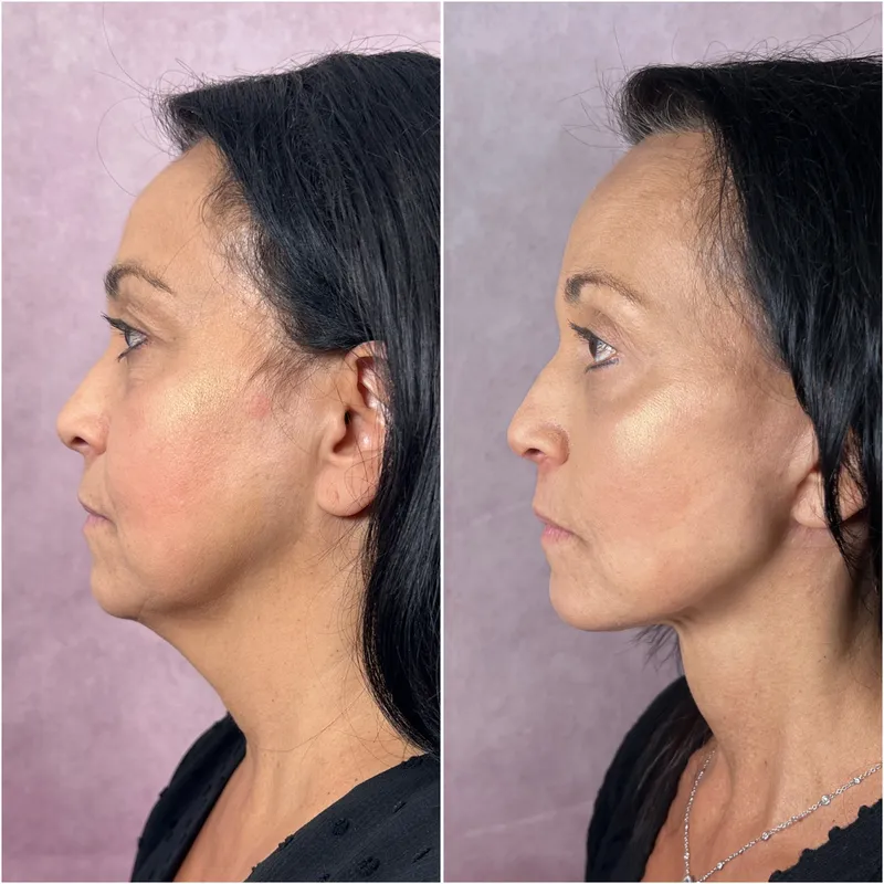 Before and after deep plane facelift — 55-year-old woman, left profile view, 6mo post-op by Dr. Compton Truesdale