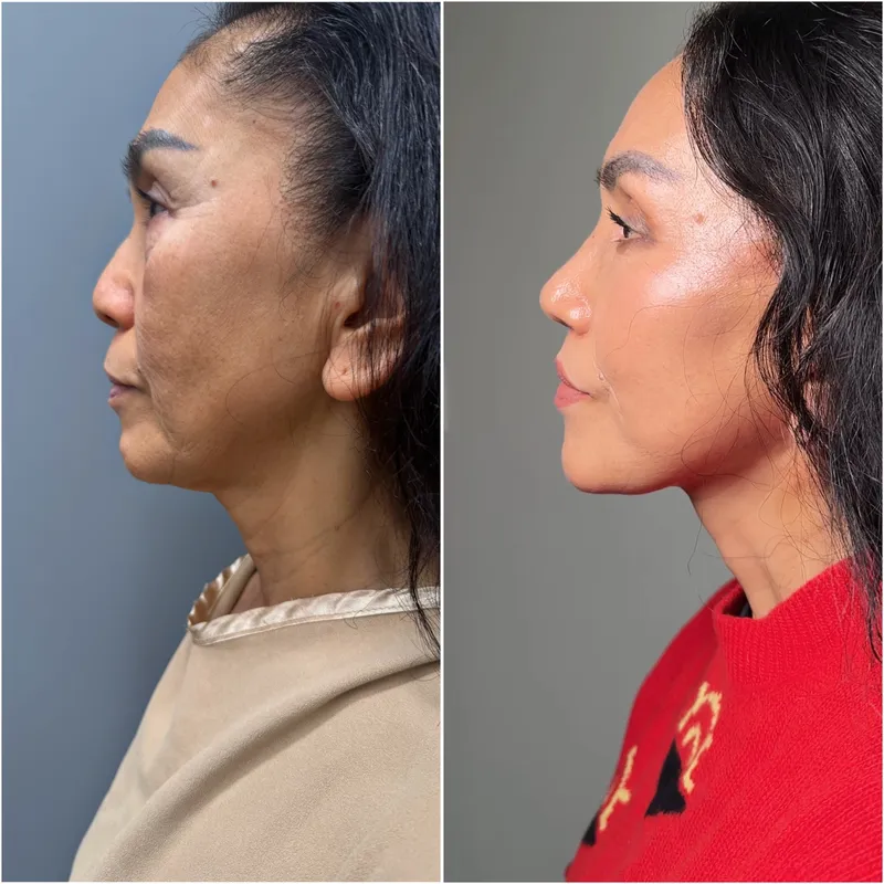 Before and after deep plane facelift — 55-year-old woman, left profile view, 6mo post-op by Dr. Compton Truesdale