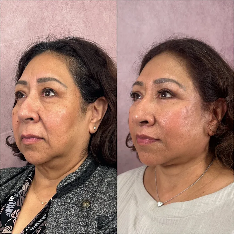 Before and after deep plane facelift — 55-year-old woman, three-quarter view, 3mo post-op by Dr. Compton Truesdale