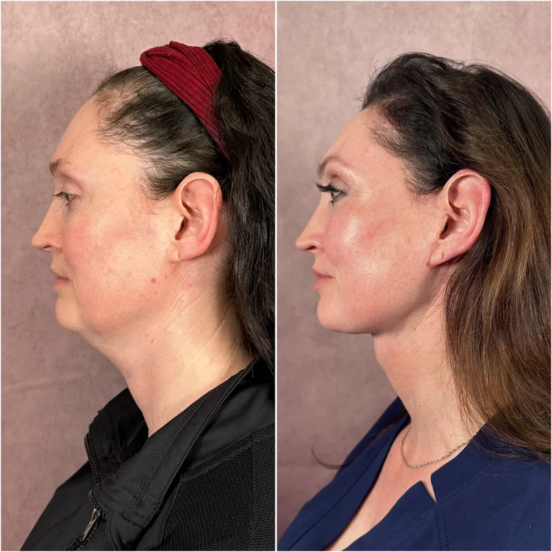 Before and after deep plane facelift — 55-year-old woman, left profile view, 6mo post-op by Dr. Compton Truesdale