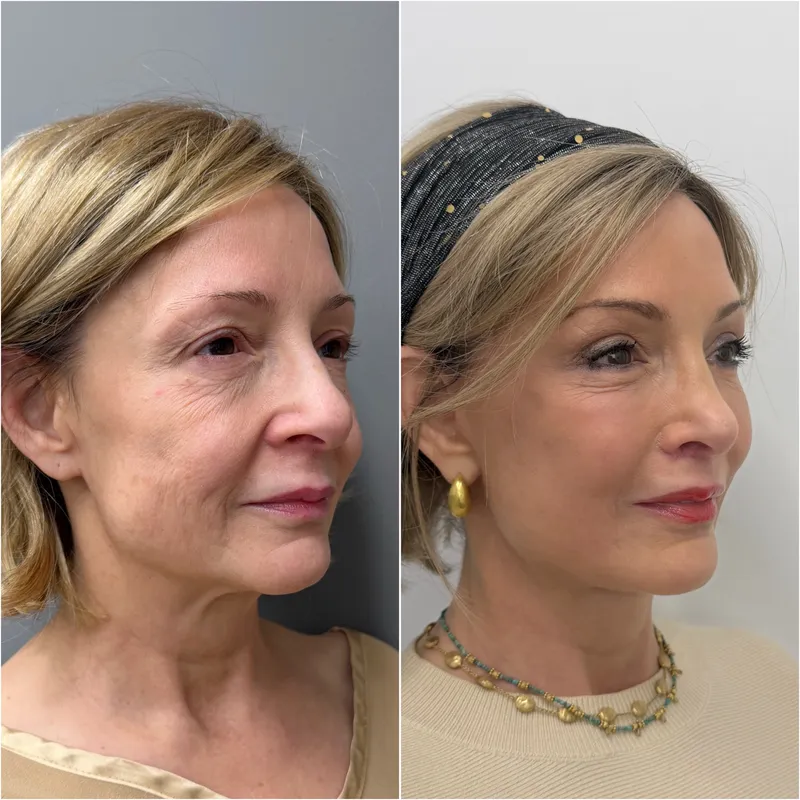 Before and after deep plane facelift — 55-year-old woman, three-quarter view, 6mo post-op by Dr. Compton Truesdale