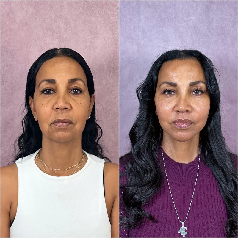 Before and after deep plane facelift — 55-year-old woman, frontal view, 6mo post-op by Dr. Compton Truesdale