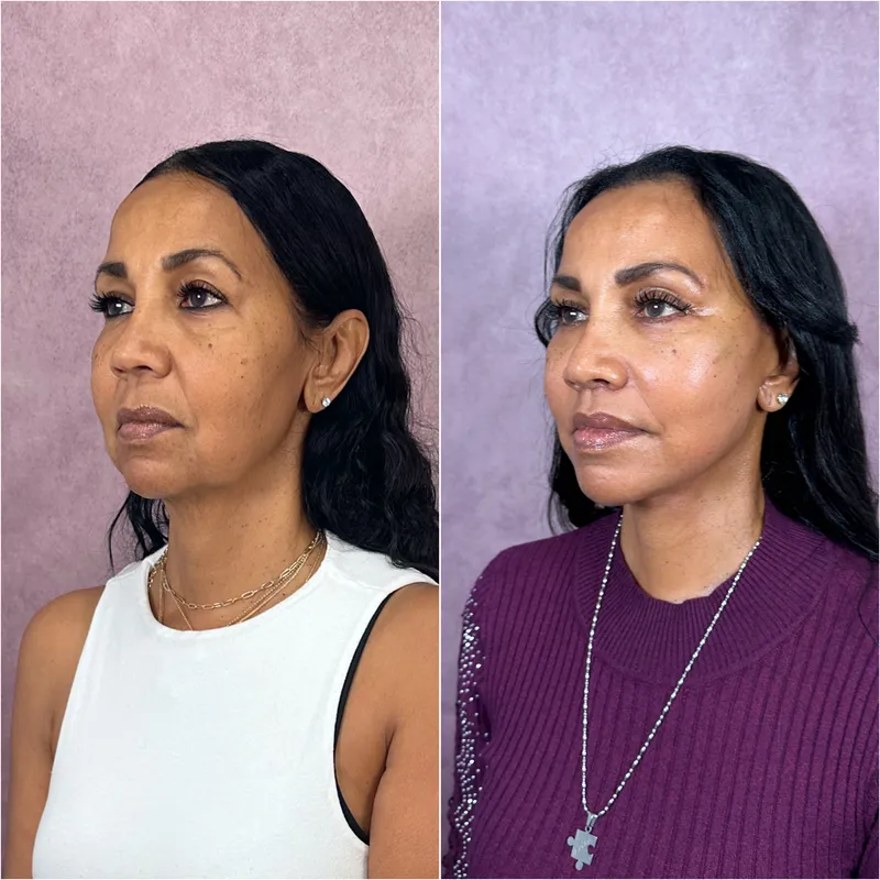 Before and after deep plane facelift — 55-year-old woman, three-quarter view, 6mo post-op by Dr. Compton Truesdale