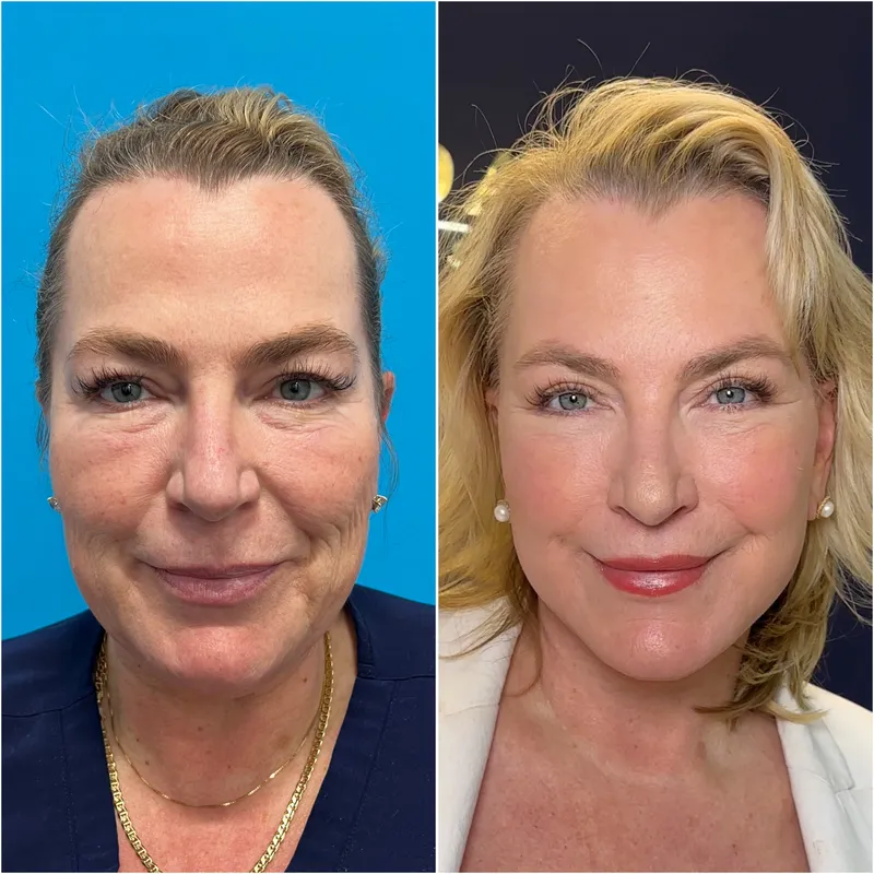 Before and after deep plane facelift — 55-year-old woman, frontal view, 6mo post-op by Dr. Compton Truesdale