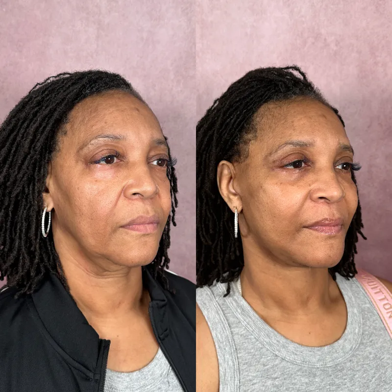 Before and after deep plane facelift — 55-year-old woman, oblique right view, 6mo post-op by Dr. Compton Truesdale