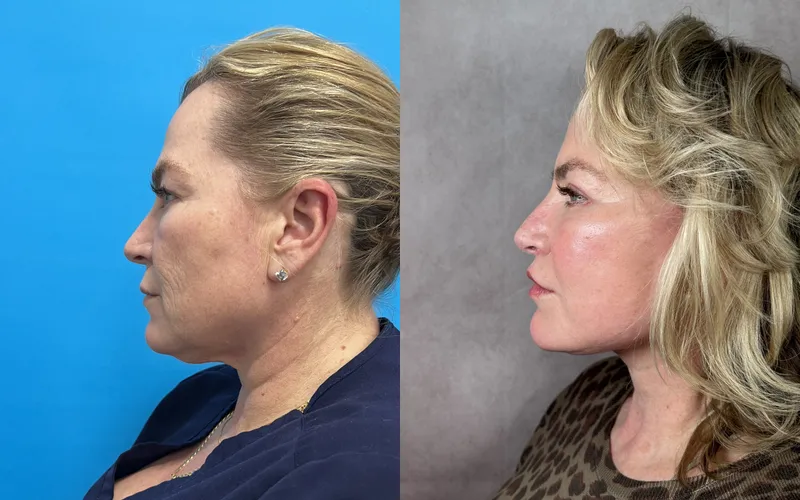 Before and after deep plane facelift — 55-year-old woman, right profile view, 6mo post-op by Dr. Compton Truesdale
