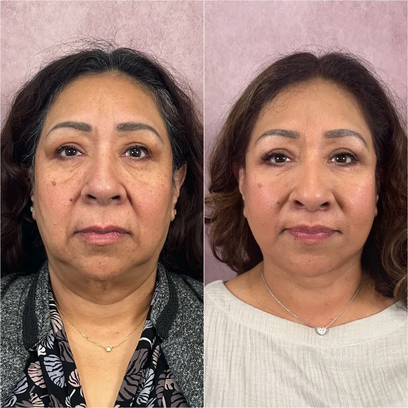 Before and after deep plane facelift — 55-year-old woman, frontal view, 6mo post-op by Dr. Compton Truesdale