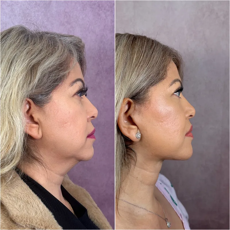 Before and after deep plane facelift — 55-year-old woman, right profile view, 6mo post-op by Dr. Compton Truesdale