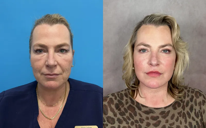 Before and after deep plane facelift — 55-year-old woman, frontal view, 6mo post-op by Dr. Compton Truesdale