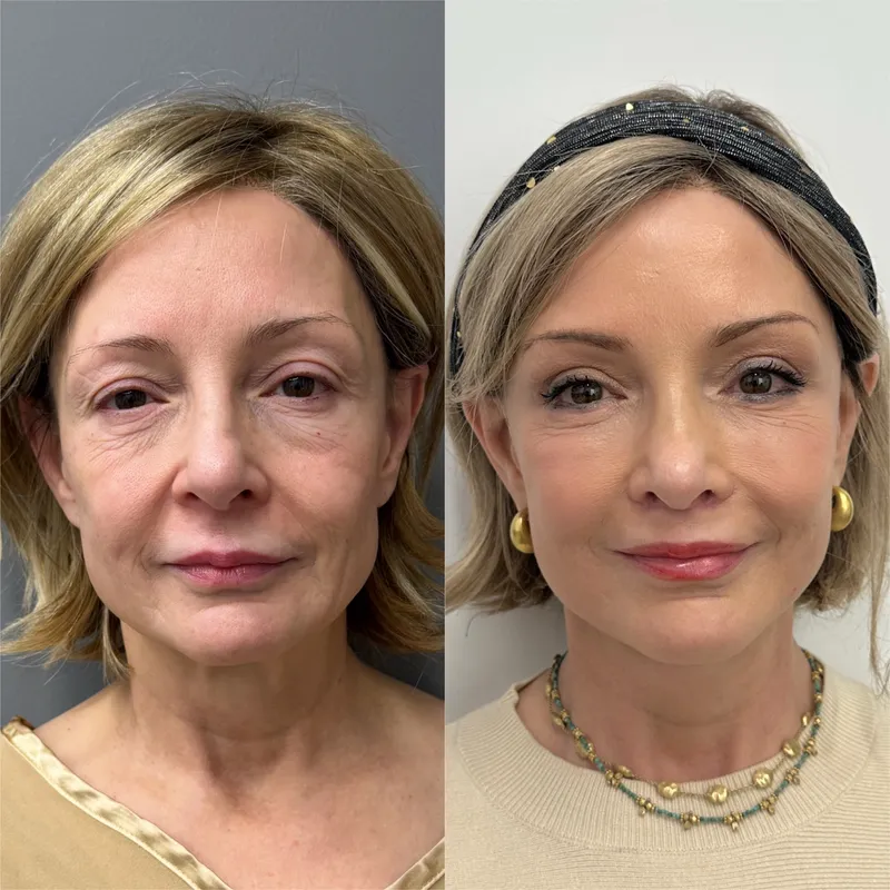 Before and after deep plane facelift — 55-year-old woman, frontal view, 6mo post-op by Dr. Compton Truesdale