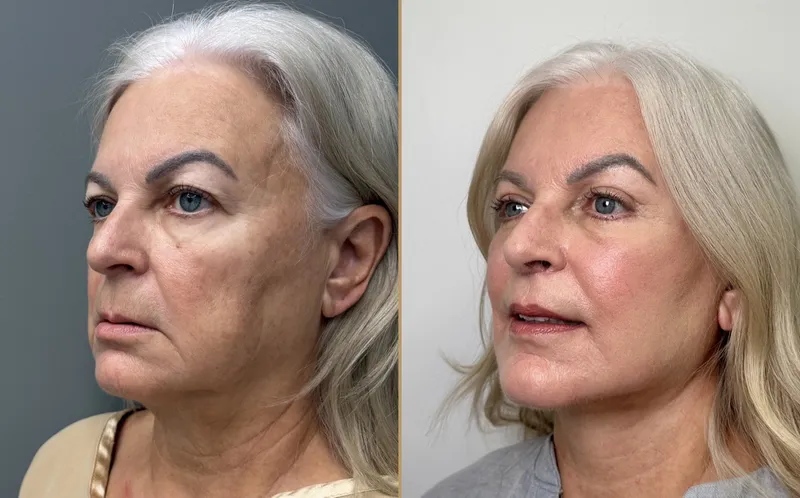 Before and after deep plane facelift — 65-year-old woman, three-quarter view, 6mo post-op by Dr. Compton Truesdale