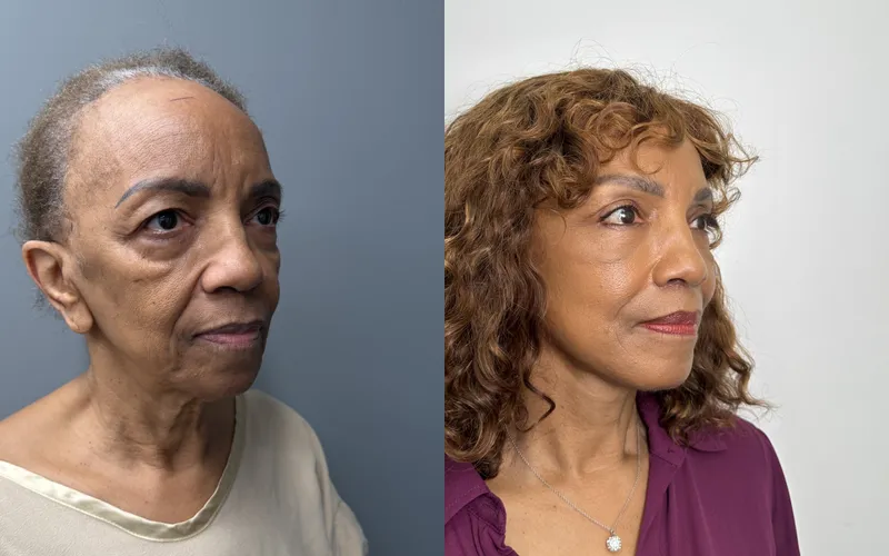 Before and after deep plane facelift — 65-year-old woman, three-quarter view, 6mo post-op by Dr. Compton Truesdale