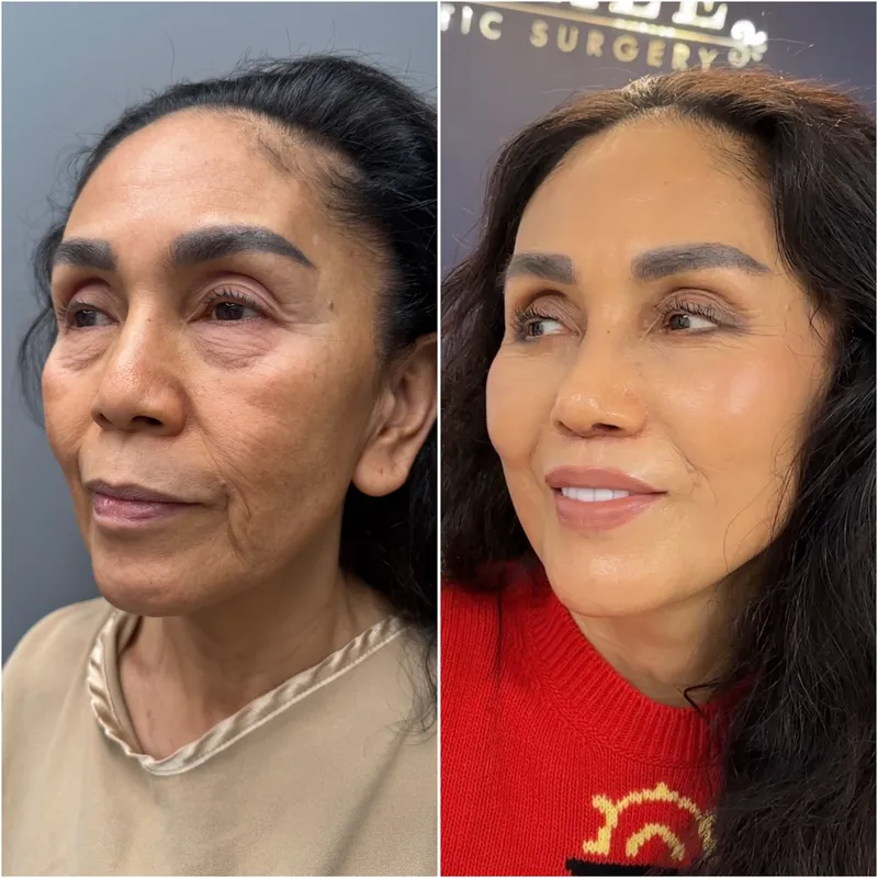 Before and after deep plane facelift — 55-year-old woman, oblique right view, 6mo post-op by Dr. Compton Truesdale