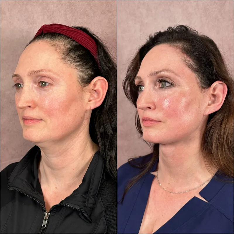 Before and after deep plane facelift — 55-year-old woman, oblique right view, 6mo post-op by Dr. Compton Truesdale