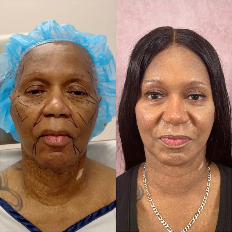Before and after deep plane facelift — 65-year-old woman, frontal view, 3mo post-op by Dr. Compton Truesdale