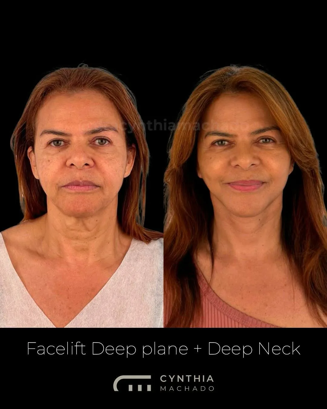 Before and after — Dr. Cynthia Machado