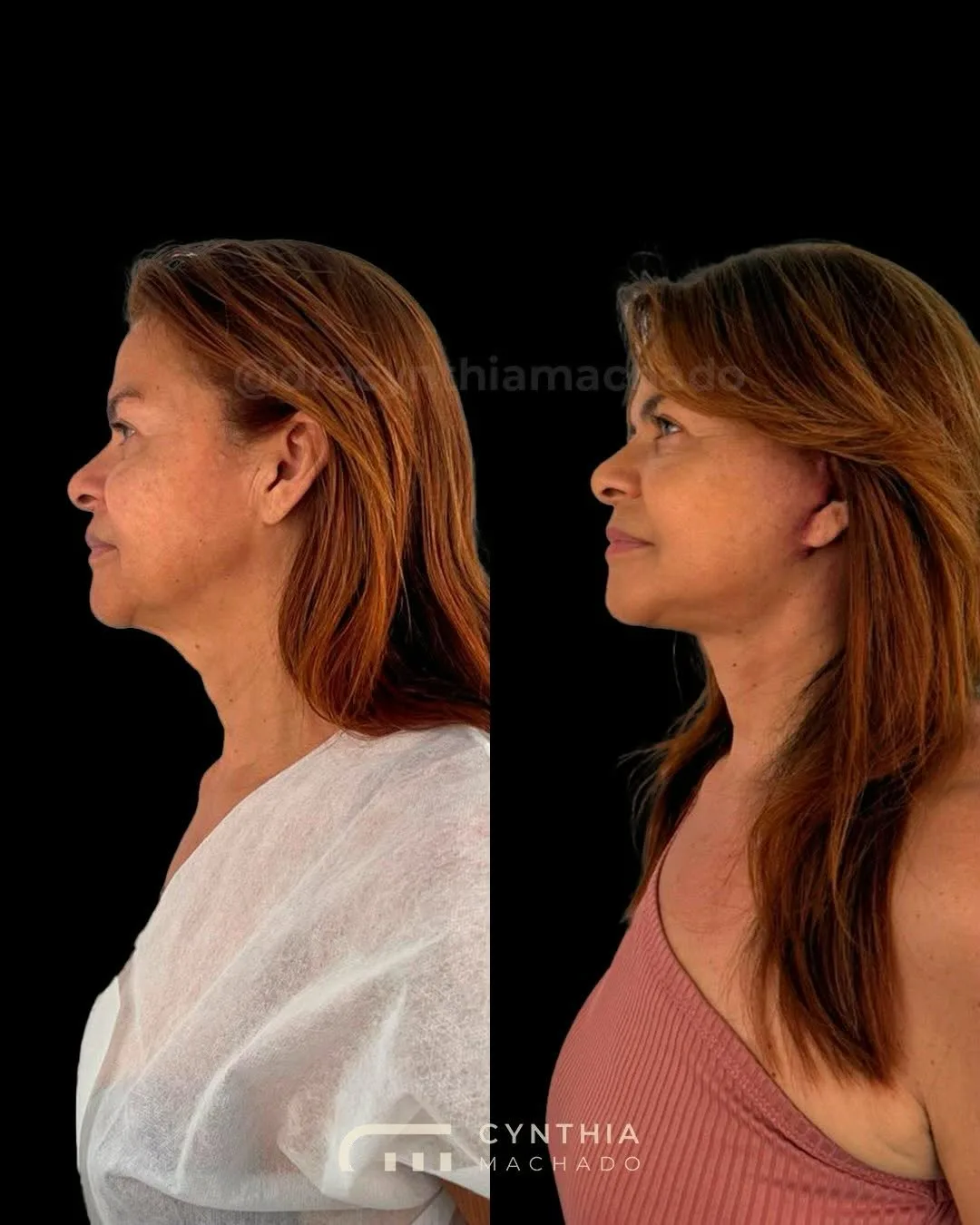 Before and after — Dr. Cynthia Machado