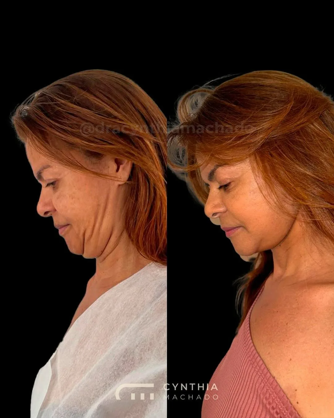 Before and after — Dr. Cynthia Machado