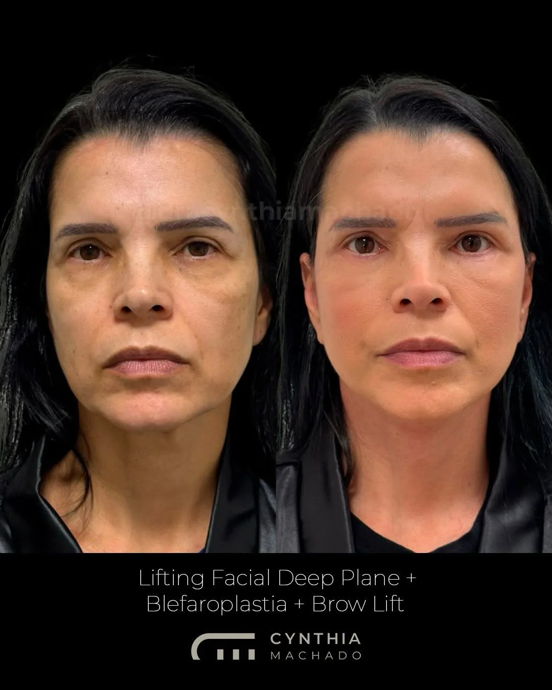 Before and after — Dr. Cynthia Machado