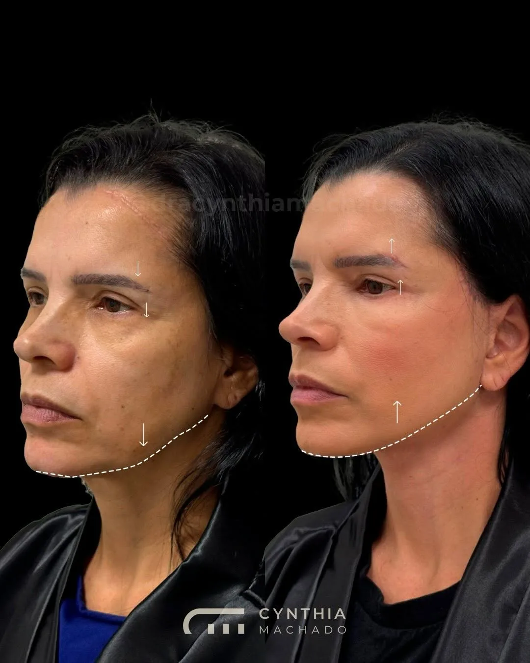 Before and after — Dr. Cynthia Machado
