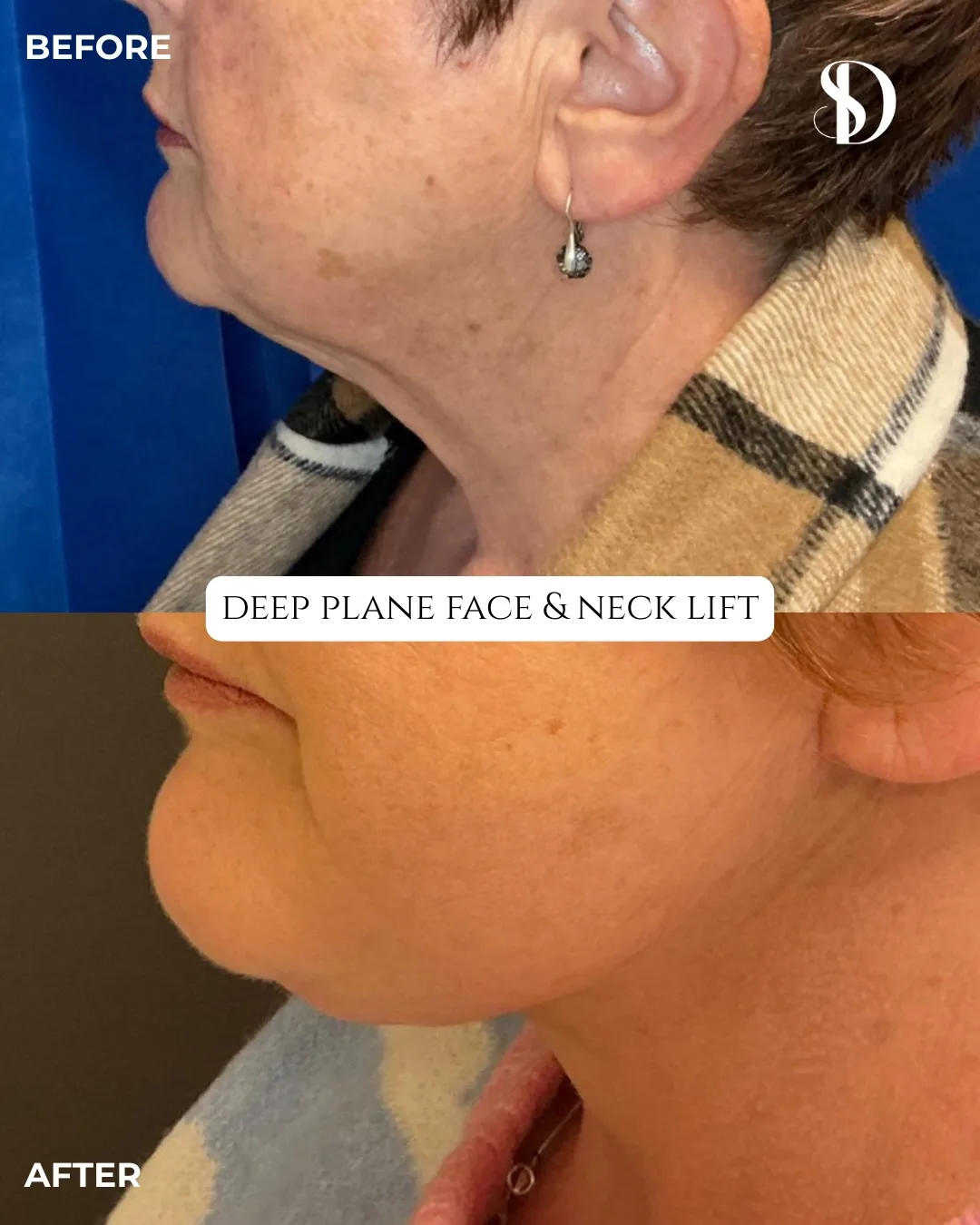Before and after deep plane facelift — 58-year-old woman, right profile view, 6mo post-op by Dr. Dan Saleh