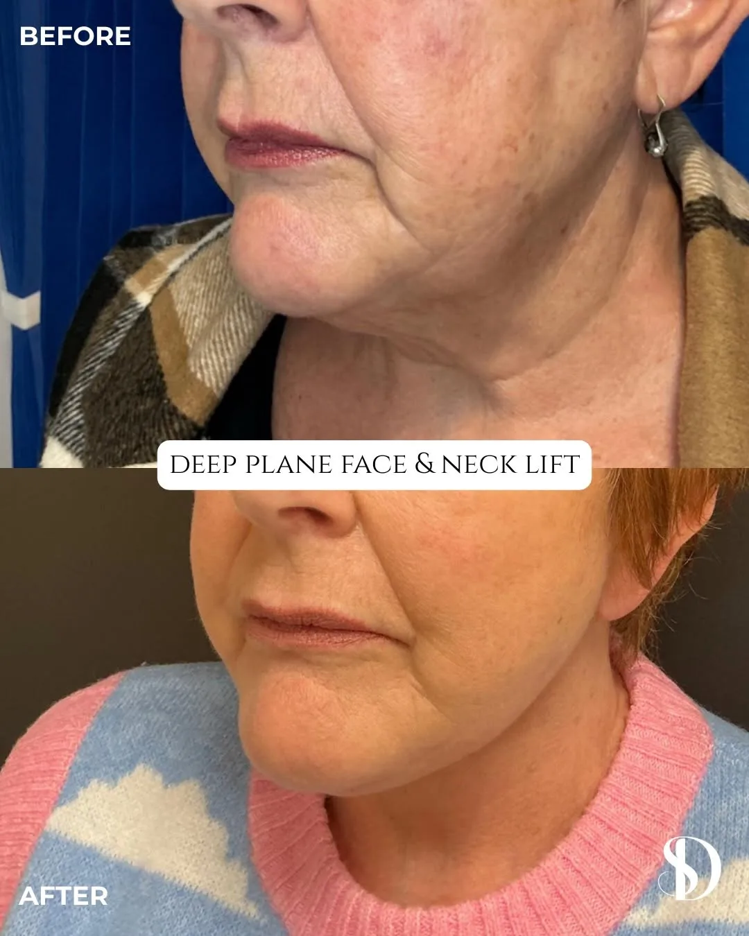 Before and after deep plane facelift — 58-year-old woman, oblique right view, 6mo post-op by Dr. Dan Saleh
