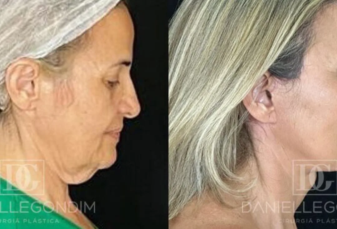 Before and after deep plane facelift — 62-year-old woman, right profile view, 9mo post-op by Dr. Dani Gondim