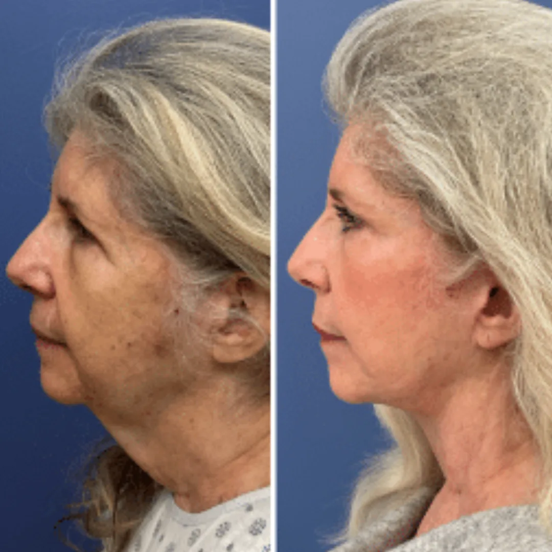 Before and after — Dr. Daniel Golshani