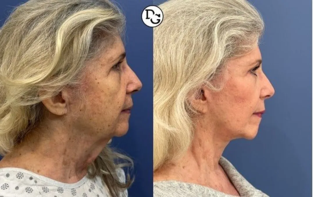 Before and after — Dr. Daniel Golshani