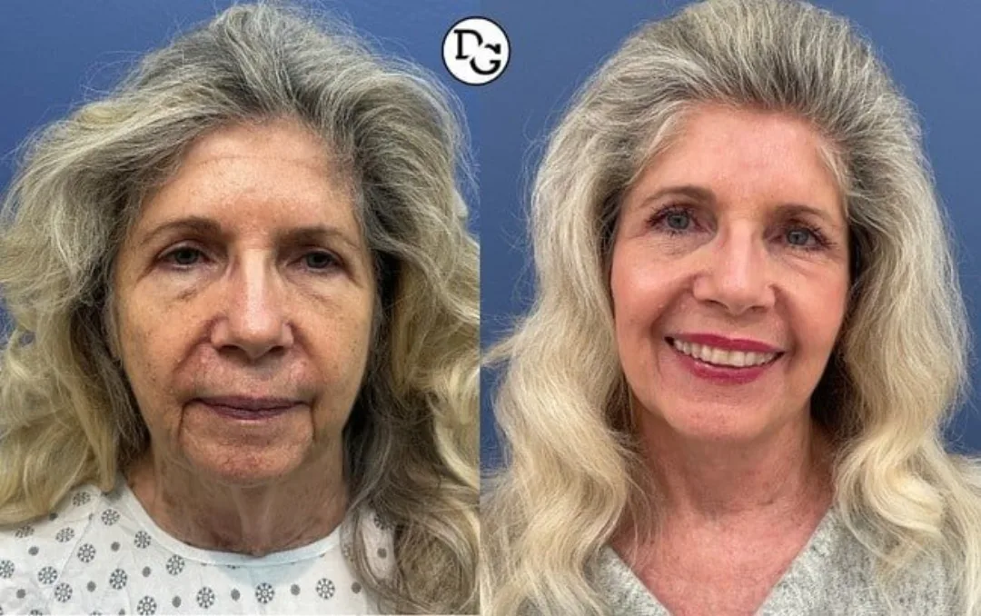 Before and after — Dr. Daniel Golshani