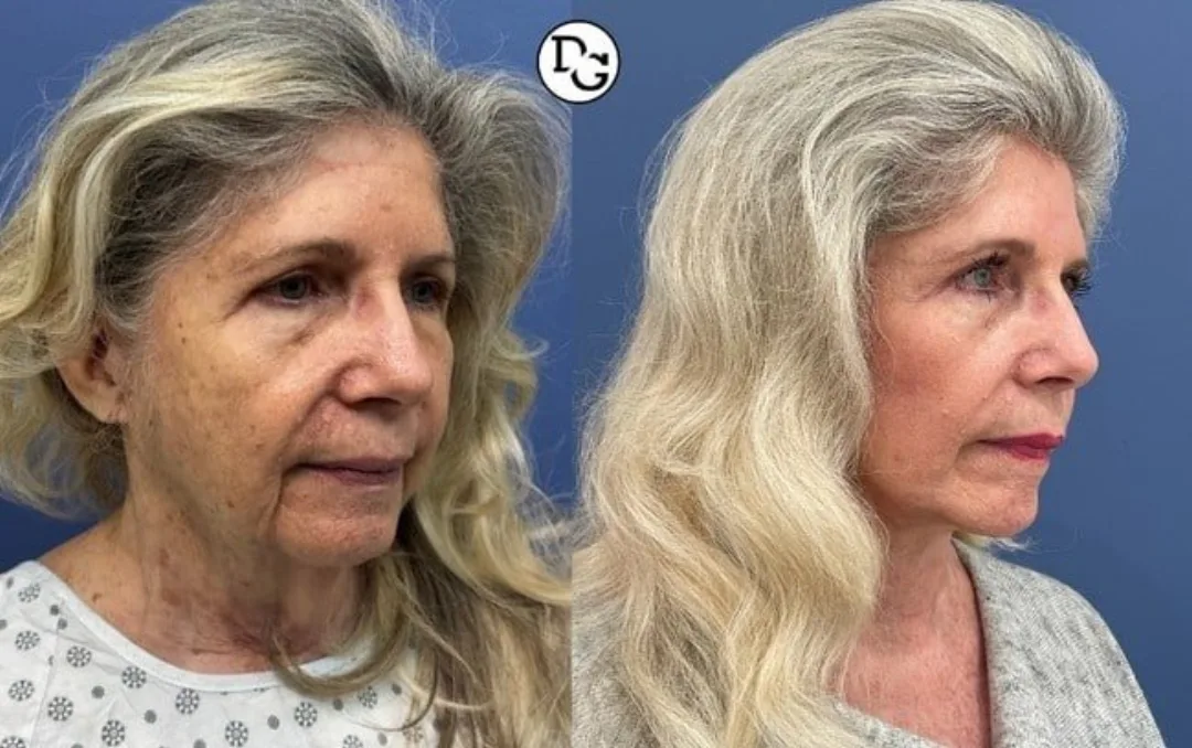 Before and after — Dr. Daniel Golshani