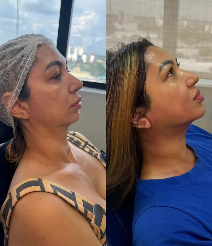 Before and after deep plane facelift — -1-year-old patient, frontal view by Dr. Danillo Marinho