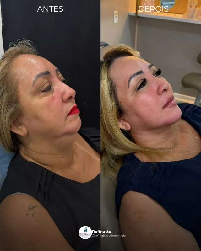 Before and after deep plane facelift — -1-year-old patient, frontal view by Dr. Danillo Marinho