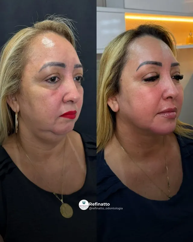 Before and after deep plane facelift — -1-year-old patient, frontal view by Dr. Danillo Marinho